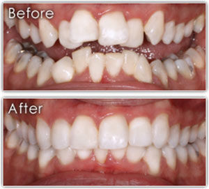 photo of 6 month braces before and after