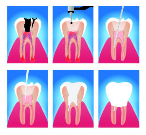 Root Canal