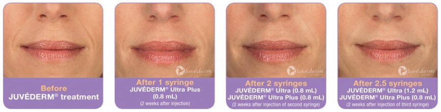 How Juvederm Works