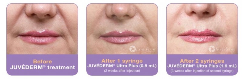 How Juvederm Works