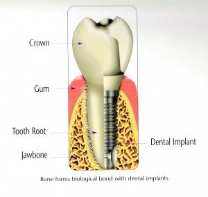 tooth implant